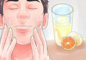 أسهل 5 طرق منزلية تضمن لك علاج حب الشباب في المنزل