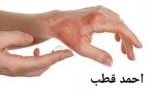 الأخطاء الشائعة في علاج الحروق